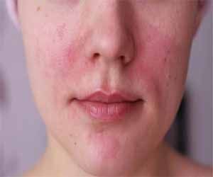 Combo helps achieve faster skin clearance in rosacea patients