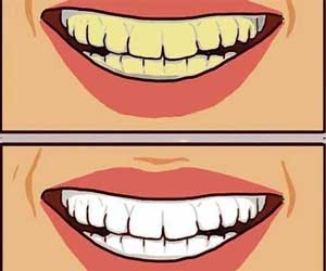 Is Doxycycline associated with tooth discoloration in Children?