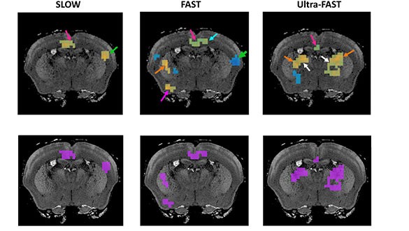 New MRI technique can capture images of thinking brain