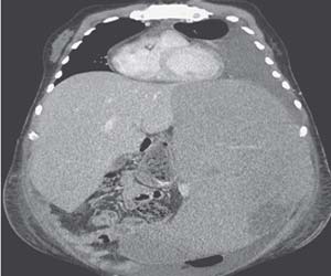 Case of massive Splenomegaly-A report