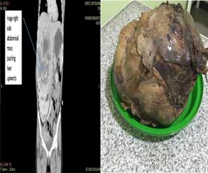 Rare case of giant solitary fibrous tumor of the adrenal gland in a child: a report