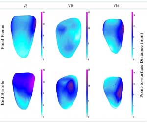 New 3D MRI technique can spot heart muscles scar without using contrast agents