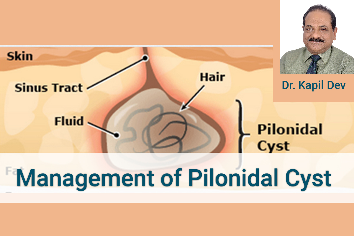 PILONIDAL SINUS, an agonising and discomforting disease- Dr Kapil Dev