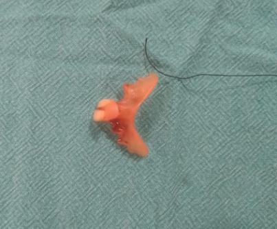 KIMS Doctors successfully remove accidentally swallowed tooth denture