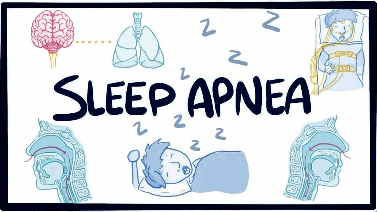 Hypoglossal nerve stimulation may improve sleep quality in sleep apnea patients: JAMA