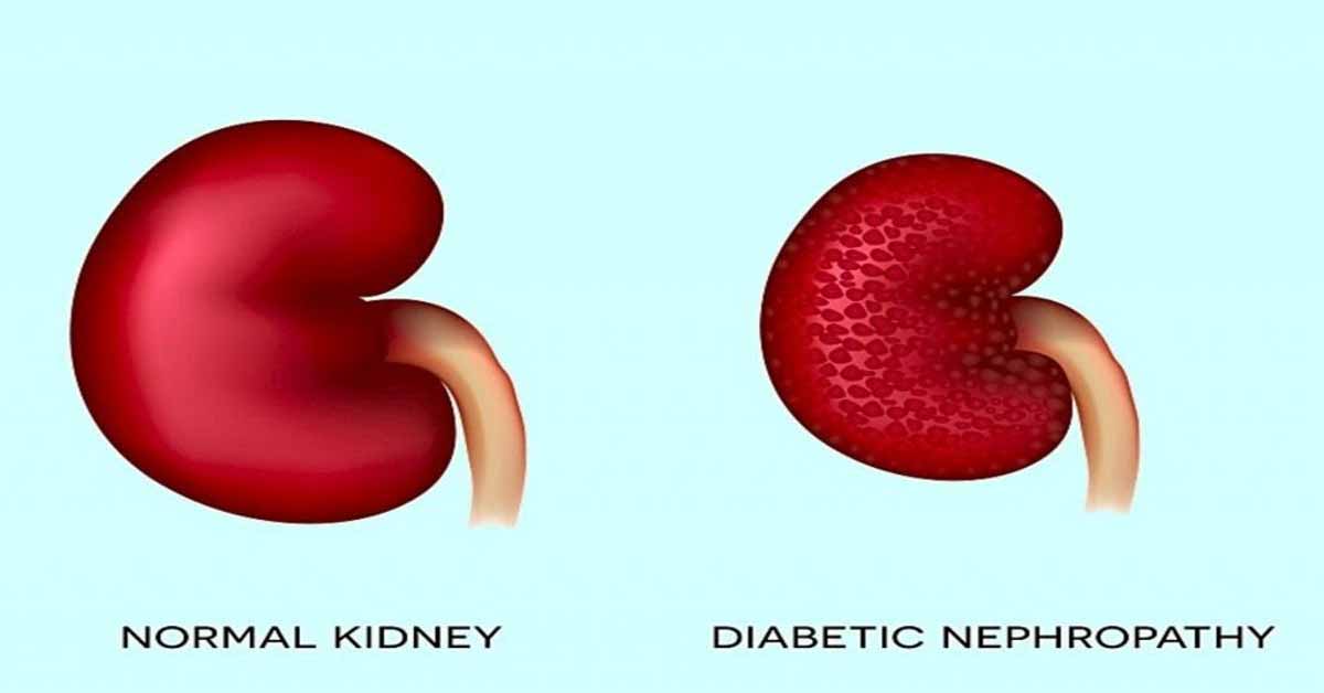 Elevated hs-CRP ups risk of diabetic nephropathy in diabetes patients: Diabetes Care