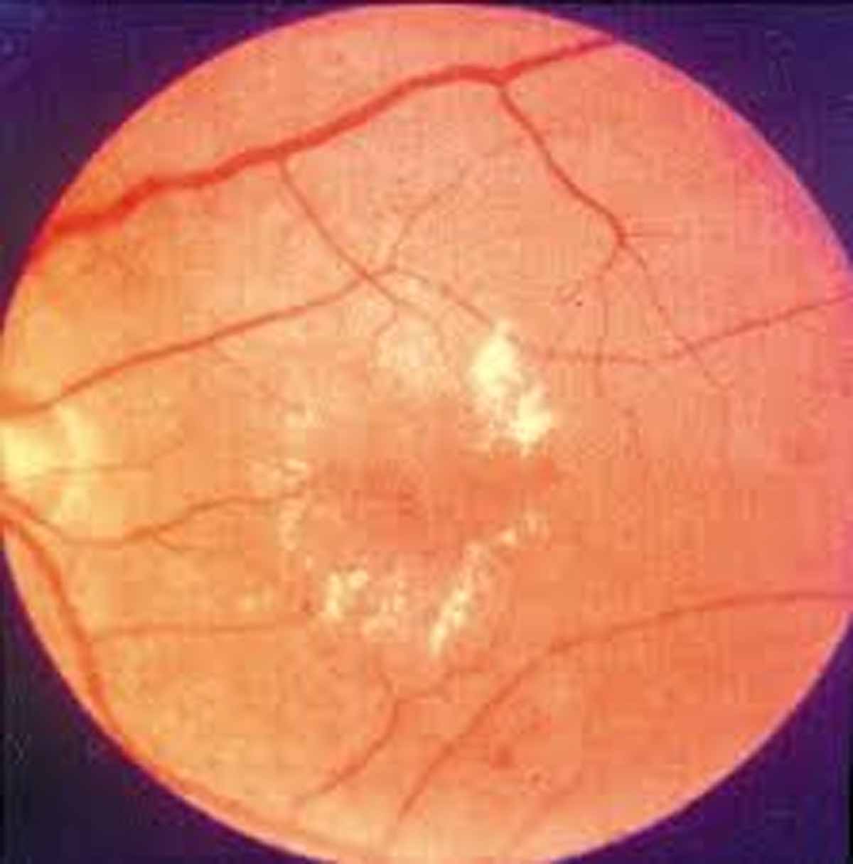 New therapeutic target may reverse Diabetic retinopathy, finds a study