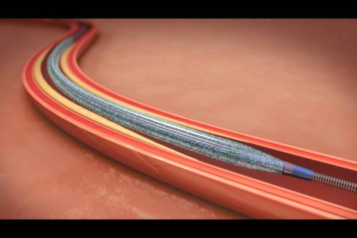 Onyx one stent with one month of DAPT non inferior to biofreedom stent in high risk patients