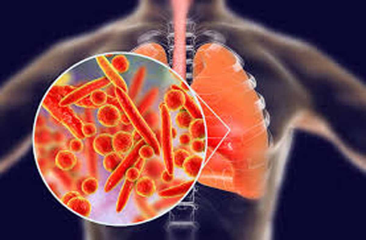 AIIMS releases antibiotic guidance for Community acquired pneumonia