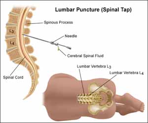 Use of Ultrasound Guidance for Adult Lumbar Puncture: Position Statement of Society of Hospital Medicine
