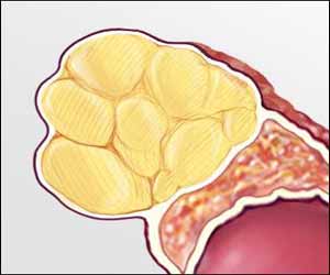 Rare case of boy with Adrenal Adenoma presenting as Ventricular Tachycardia: a report