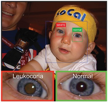A Smartphone App helps parents detect early signs of white eye in children, Study Finds