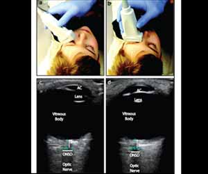 Bedside eye ultrasound quick method to diagnose raised intracranial pressure