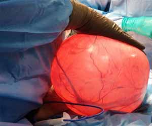 Fortis Hospital doctors successfully remove football-sized ovarian cyst from 63-year-old woman