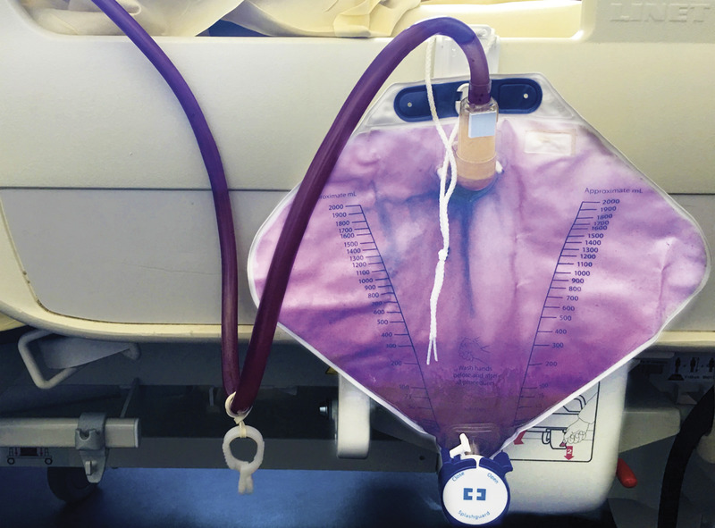 Case of Purple Urine after catheterization- a dilemma