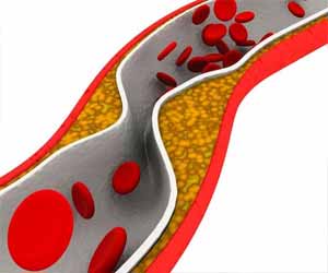 Icosapent ethyl slows progression of atherosclerosis significantly: EVAPORATE trial