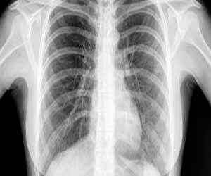 AI may detect clinically meaningful chest X-ray findings at par with radiologists: Radiology study
