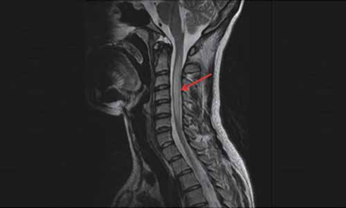 Rare case of Subacute combined degeneration induced by nitrous oxide inhalation