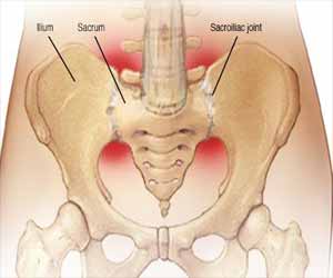 Acne drug Isotretinoin may lead to sacroiliitis