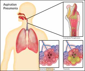 DPP-4 inhibitors may increase risk of aspiration pneumonia