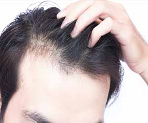To balding ways stop Preventing hair