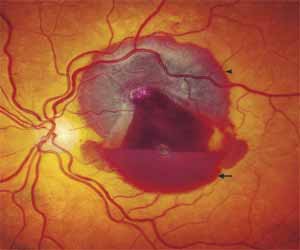 Chandigarh doctor reports rare case of retinal haemorrhage from blunt ...