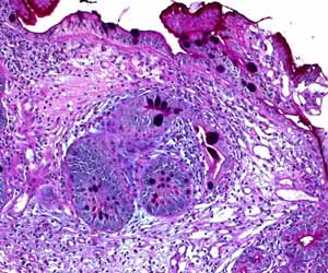 Management of gastric intestinal metaplasia-AGA guidelines