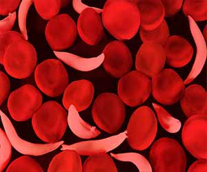 Arginine supplementation significantly reduces pain in kids with sickle cell anemia