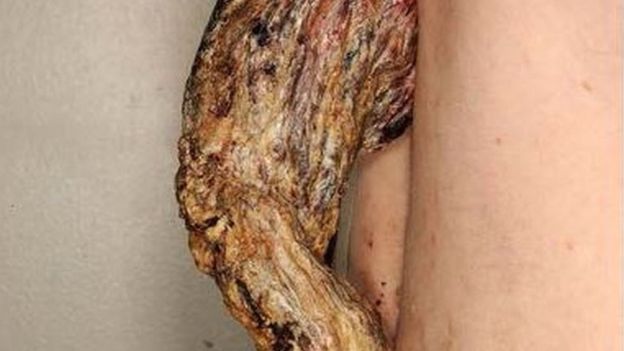 Doctors remove five-inch long cancerous “dragon horn” from back of patient