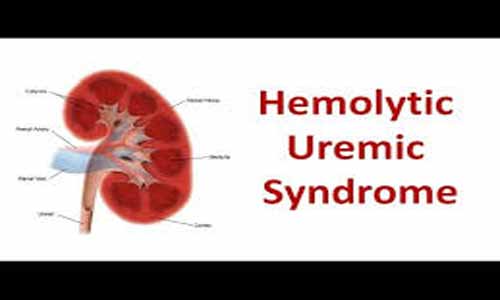 Rare case of Atypical hemolytic uremic syndrome: a report