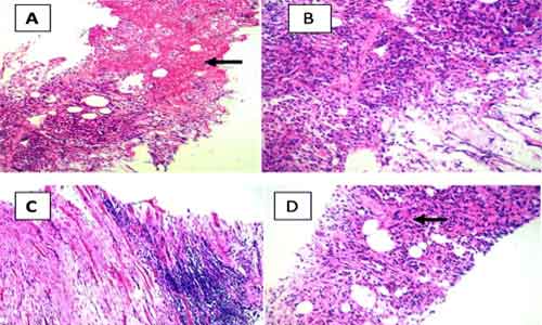 Proper sleep for 7 hours may help treat Pulmonary Fibrosis, finds study